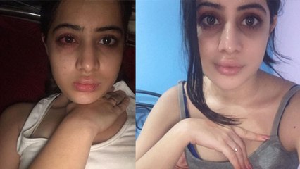 Urfi Javed Lip Fillers Journey Viral, 18 Year Age से ले रही Botox Treatment,Fans को Advice | Boldsky
