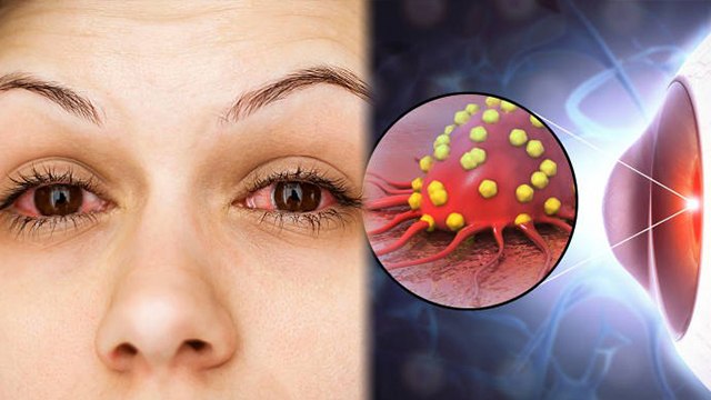 आई फ्लू क्यों फ़ैल रहा है | Eye Flue Kyu Fail Raha Hai | Eye Flu Kaise Thik Kare | | Boldsky