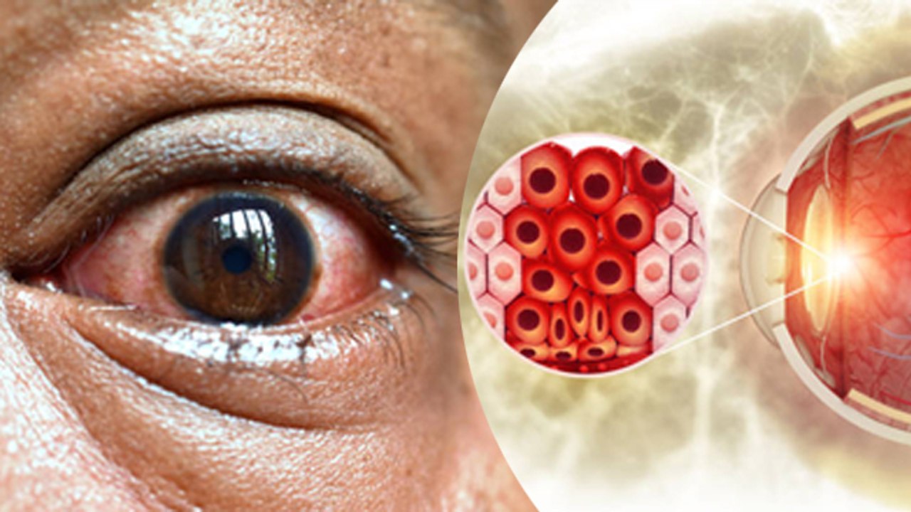 Eye Infection और Eye Allergy में क्या Difference | Allergic Conjunctivitis Symptoms In Hindi |