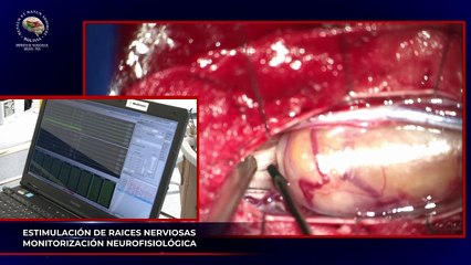 RESECCIÓN NEURINOMA L4 MONITORIZADO