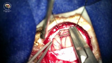 DESCOMPRESIÓN MICROVASCULAR ESPASMO HEMIFACIAL