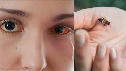 Eye Flu पर Delhi AIIMS Guideline, Fly से फैल रहा Conjuctivitis | Boldsky
