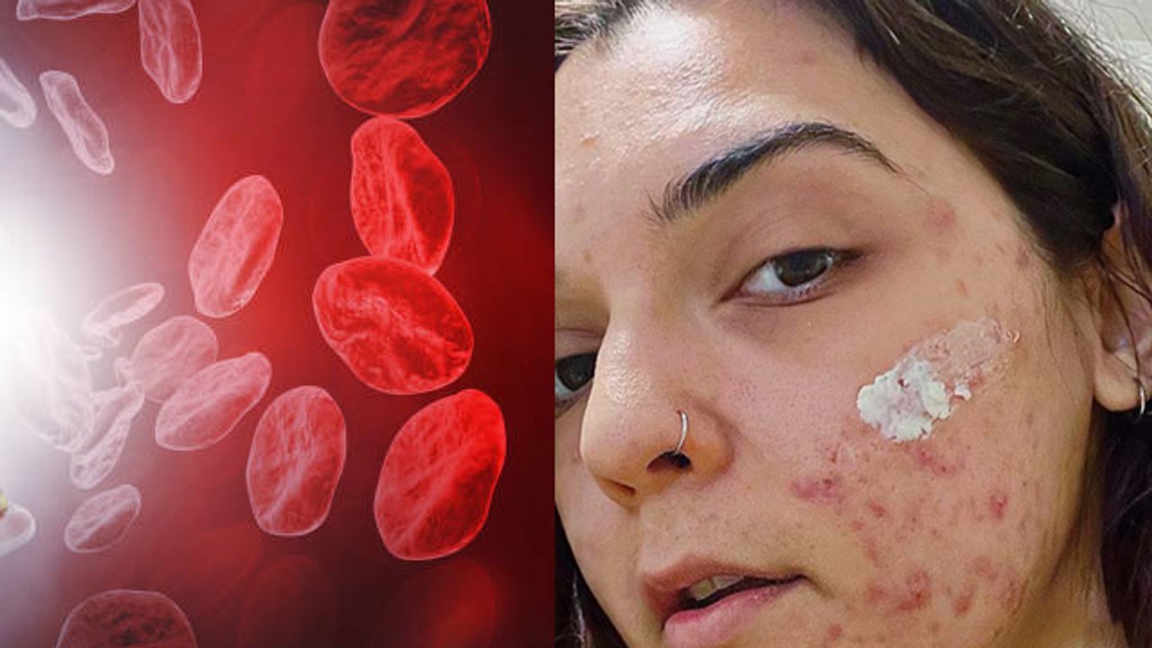 हार्मोनल एक्ने कैसे ठीक करें | Hormonal Acne Ka...