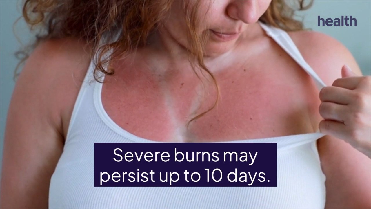 How Long You Can Expect a Sunburn to Last—and How To Treat It