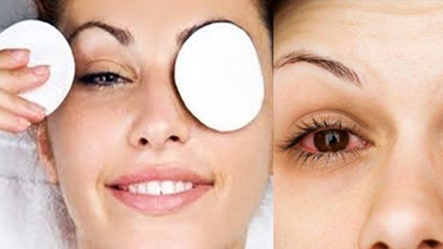 Eye Flu Kacche Aalu Se Kaise Thik Kare | आई फ्लू का इलाज और घरेलू उपाय | Boldsky