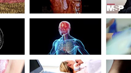 Día Mundial del Cáncer de Cabeza y Cuello - Todo lo que debes saber - #ExclusivaMSP