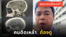 หมอผ่าตัดสมอง เผยภาพ CT scan คนติดเหล้าหนัก พร้อมเตือนเป็นไปได้ ลดละเลิก