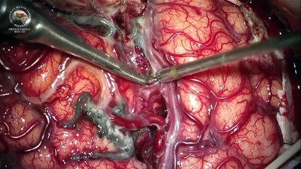 RESECCIÓN MALFORMACIÓN ARTERIOVENOSA FRONTAL EMBOLIZADA