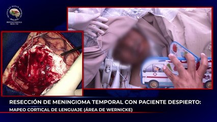 RESECCIÓN DE MENINGIOMA TEMPORAL CON PACIENTE DESPIERTO MAPEO CORTICAL DE LENGUAJE (ÁREA DE WERNICKE)