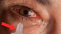 Eye Flu Me Eye Drop Use Karna Sahi Ya Nahi | Eye Flu Me Konsi Drop Dale | Boldsky