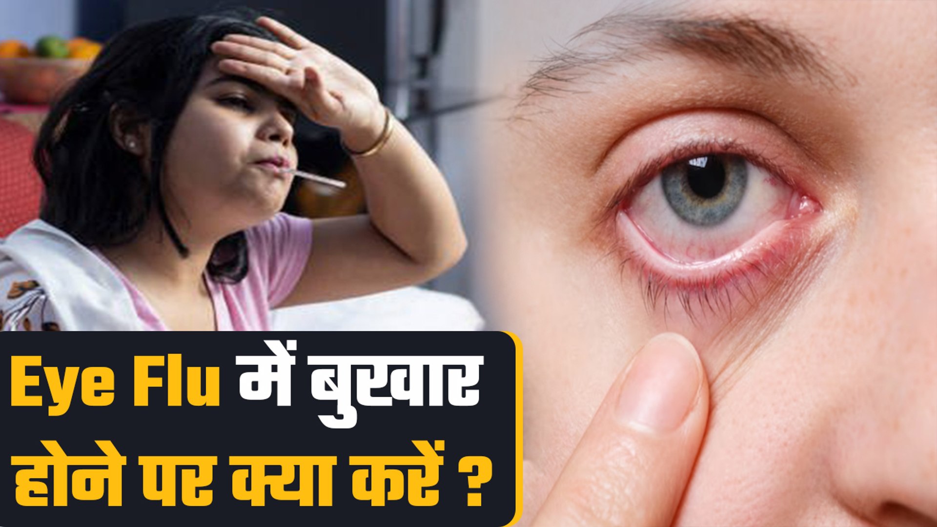 ⁣आई फ्लू में बुखार होने पर क्या करें | Eye Flu Mein Fever Hone Par Kya  Kare |Boldsky