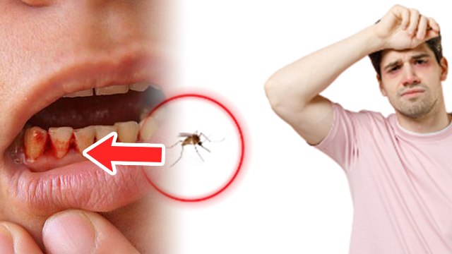 Dengue Fever Symptoms In Hindi: Dengue Bukhar Ka Pehla Lakshan | Dengue Bukhar Ka Pehla Sanket