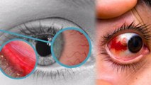 Eye Flu Like Symptoms हर बार Conjunctivitis नहीं, Dry Eye से लेकर Subconjunctival Haemorrhage Reason