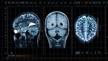 Frau klagt über Kopfschmerzen: Dann finden Ärzte das in ihrem Gehirn