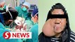 Lahad Datu hospital removes 1.03kg growth from woman's face