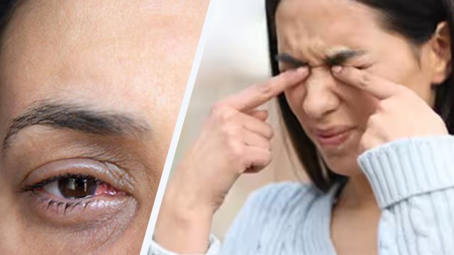 आई फ्लू ठीक होने के बाद कैसे रखें ख्याल | Eye Flu Theek Hone Ke Baad Kaise Care Kare | Boldsky