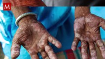 Aumentan los contagios de Lepra en México