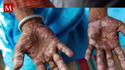 Aumentan los contagios de Lepra en México