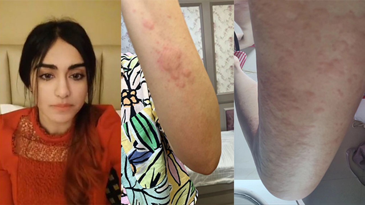 Adah Sharma Skin Allergy Photos Viral, Emotional Note में Break Reason Reveal | Boldsky