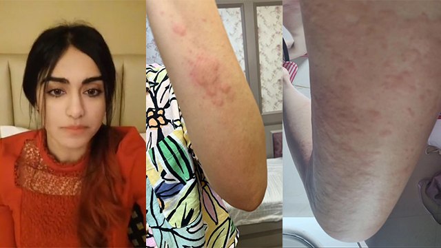 Adah Sharma Skin Allergy Photos Viral, Emotional Note में Break Reason Reveal | Boldsky
