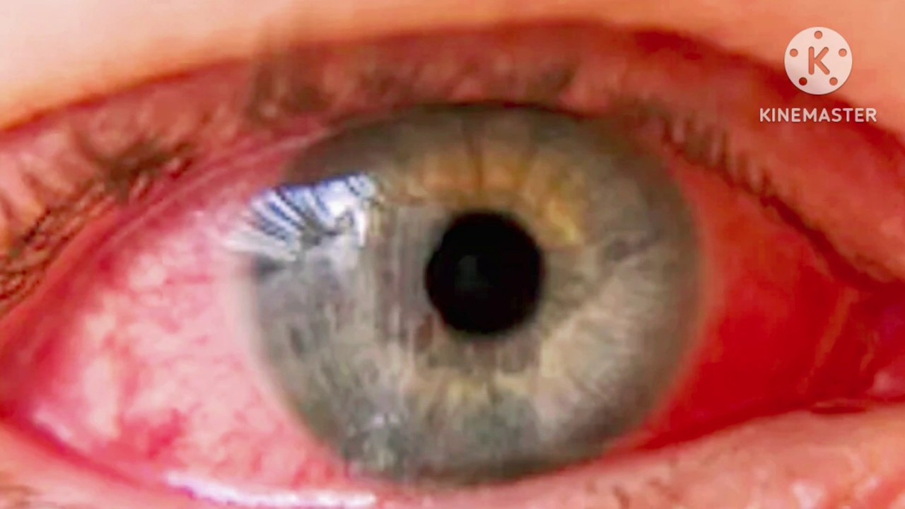 Pink eye infection video Dailymotion