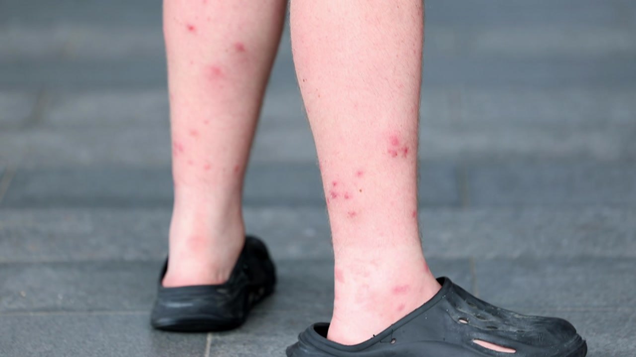 [영상] 잼버리를 악몽으로 만든 화상벌레..."절대 만지지 마세요" / YTN - 동영상 Dailymotion