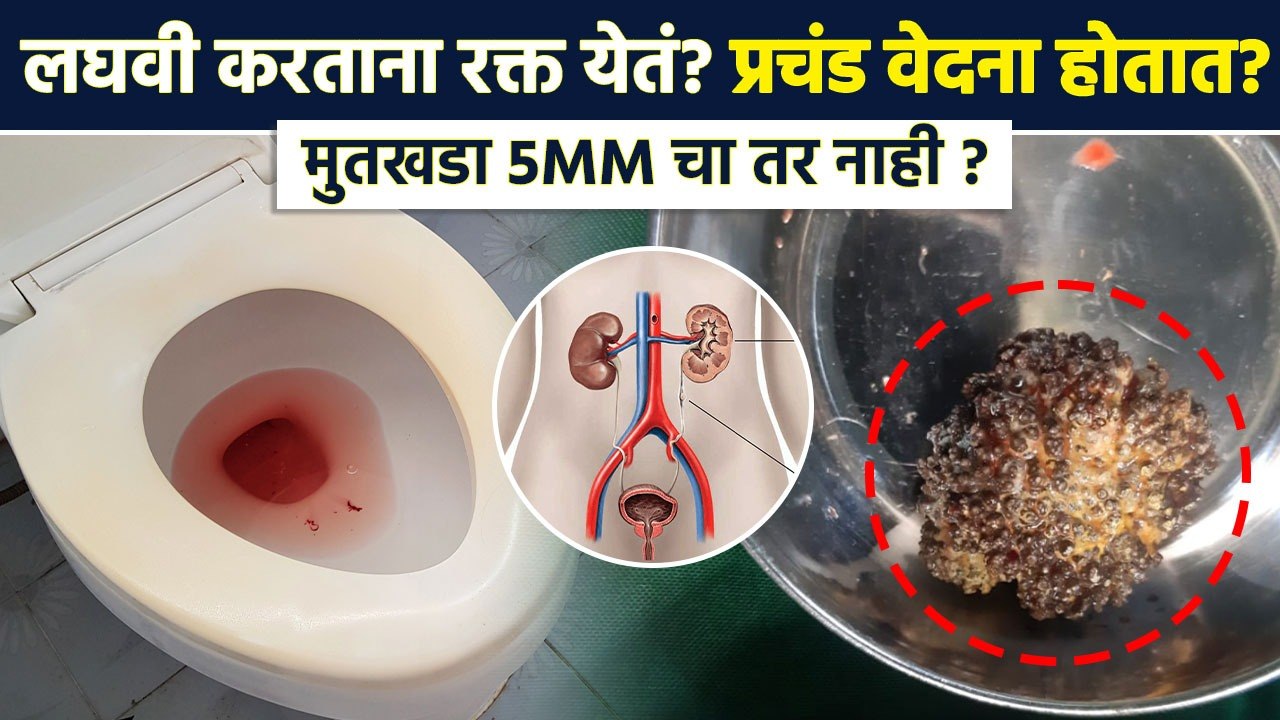 मुतखड्याकडे किती दिवस करणार दुर्लक्ष ? | Kidney Stone | Blood Through Urine | Lokmat Sakhi | RI3