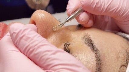 Professional esthetician displays UNREAL concentration while performing Extractions