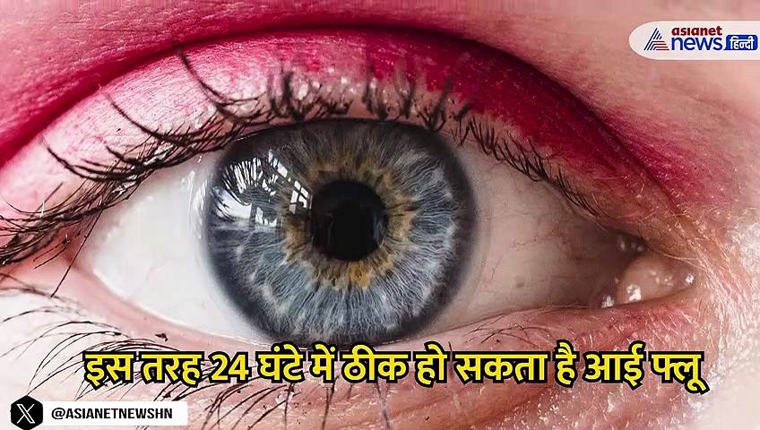 conjunctivitis treatment: इस तरह सिर्फ 24 घंटे में ठीक करें Eye Flu- Video