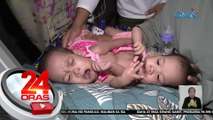 Conjoined twins mula Maguindanao del Sur, idinulog sa GMA Kapuso Foundation | 24 Oras