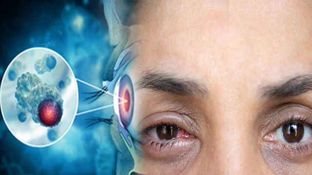 Eye होने पर भूलकर भी न करें ये 1 गलती, Eye Flu Home Remedies in Hindi | Boldsky