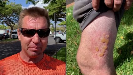 Hawaii wildfires ‘like apocalypse’, says local who was burnt driving through blaze