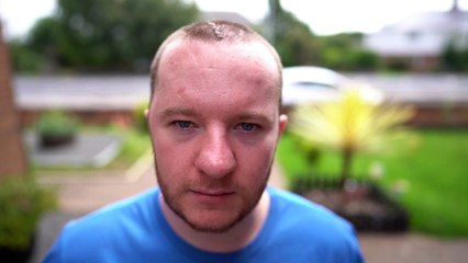 Man left with half his skull missing following assault has it rebuilt with plastic