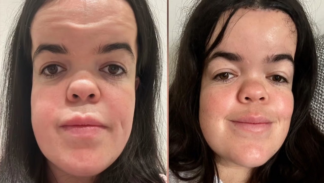 BBC Traitors winner Meryl Williams ‘more confident than ever’ as she shows results of forehead surgery