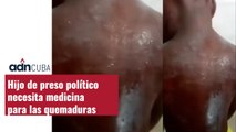 Hijo de preso político necesita medicina para las quemaduras