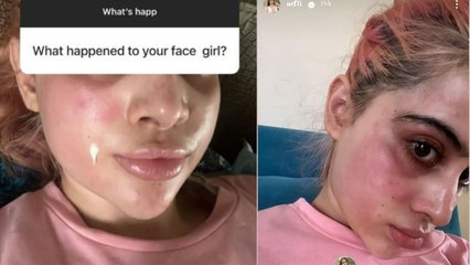 Urfi aka Uorfi Javed का खूबसूरत दिखने के चक्कर में Surgery करवा बिगड़ा चेहरा,रोते हुए बयां किया दर्द