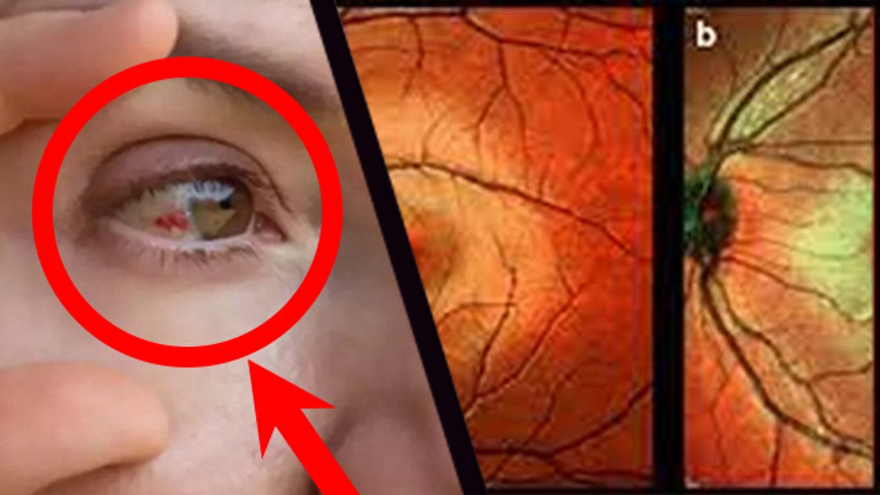 Eye Flu Repeat Hota Hai Kya | Eye Flu Repeat Kyu Ho Raha Hai | Eye Flu Dobara Ho Sakta Hai Kya