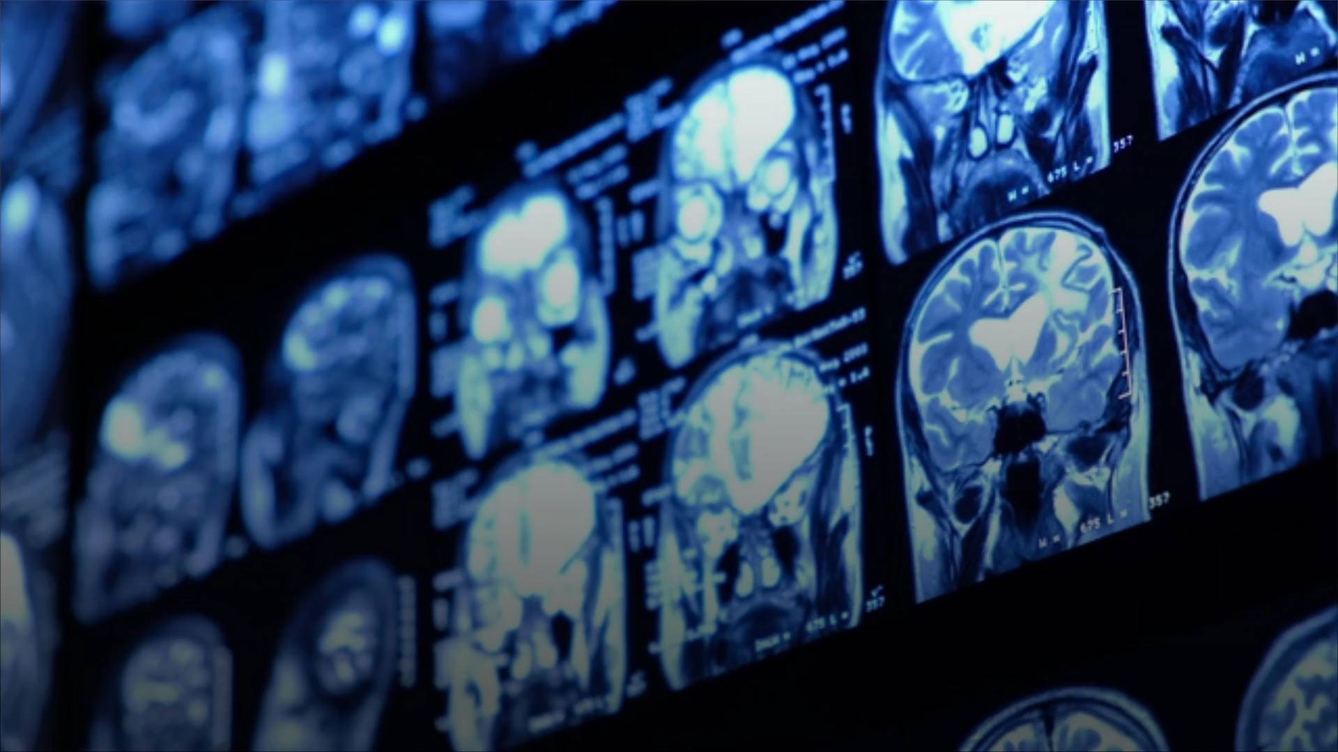 Artificial Intelligence Reconstructs Music From People's Brain Activity Data