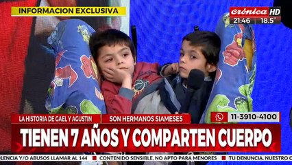 Son siameses y necesitan apoyo económico para seguir viviendo