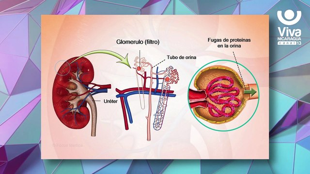 Estos son los signos y síntomas del síndrome nefrótico y nefrítico en niños