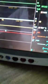How to connect Pulse Oximeter probe to the Cardiac Monitor