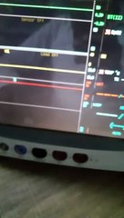 How to connect Pulse Oximeter probe to the Cardiac Monitor