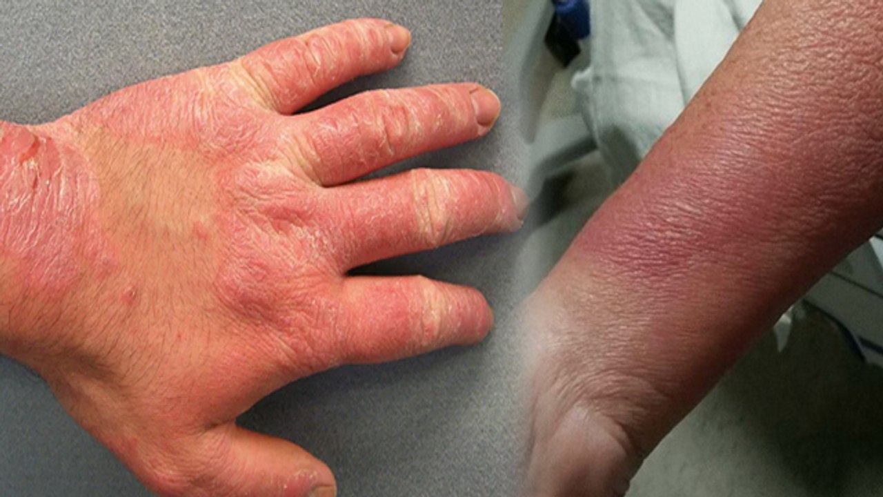 Chronic Inflaminmation Kya Hota Hai | Arthritis से लेकर High Blood Pressure का खतरा कैसे | Boldsky