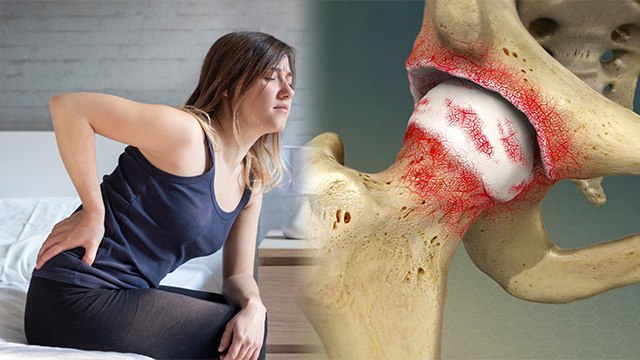 Hip Arthritis Kya Hota Hai | Hip Arthritis Symptoms In Hindi | Hip Arthritis Reason In Hindi|Boldsky