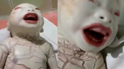 Harlequin Ichthyosis Disease क्या है | Body से लेकर Feet तक, Skin Defect के साथ Women ने दिया Birth