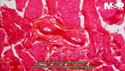 Todo lo que debes saber sobre el cáncer de lengua - #ExclusivoMSP