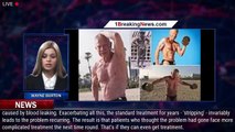 Beware of the outdated surgery that makes varicose veins worse - 1breakingnews.com