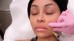 Blac Chyna shocks fans by posting video of her agonising SIXTH facial filler dissolving op
