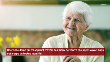 Une vielle dame se plaint de maux de ventre…et les médecins découvrent un foetus momifié dans son corps !