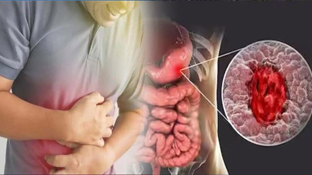 Peptic Ulcer क्या है | पेप्टिक अलसर क्यों होता है | Peptic Ulcer Kyu Hota Hai | Boldsky